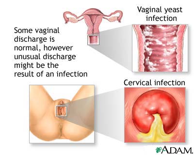 Vaginal discharge Vaginal discharge