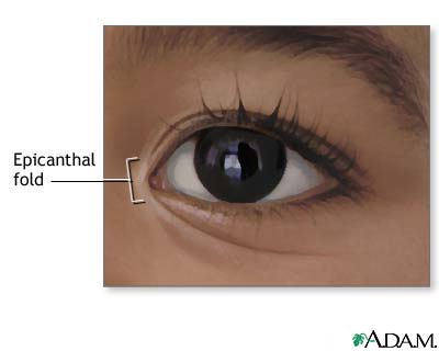 Epicanthal fold