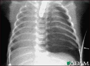 Pneumothorax - chest X-ray