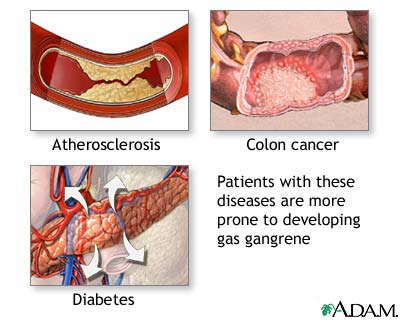 Gas gangrene