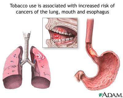 Tobacco and cancer Tobacco and cancer
