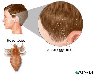 Head lice Head lice