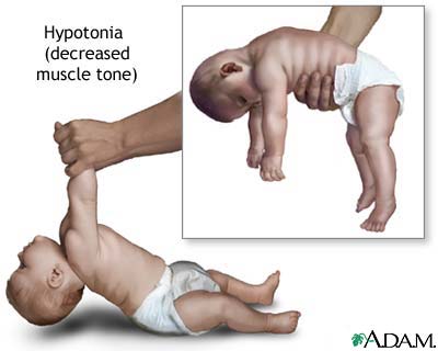 Hypotonia