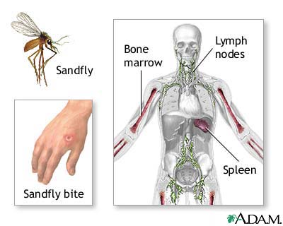 Leishmaniasis