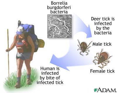 Lyme disease