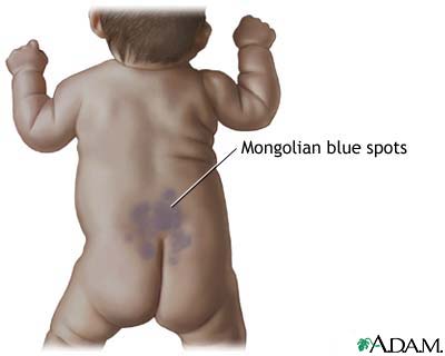 Mongolian blue spots Mongolian blue spots