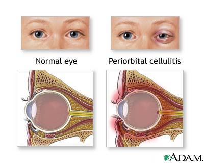 Periorbital cellulitis