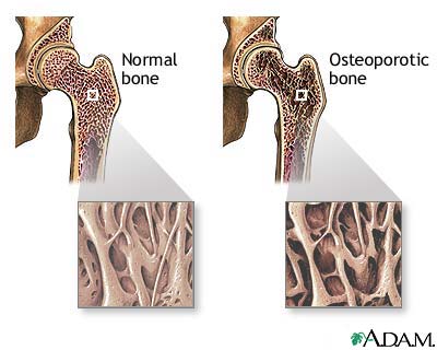 Osteoporosis