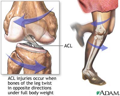 ACL injury ACL injury