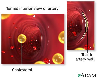 Arterial tear in internal carotid artery