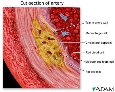 Enlarged view of atherosclerosis Enlarged view of atherosclerosis