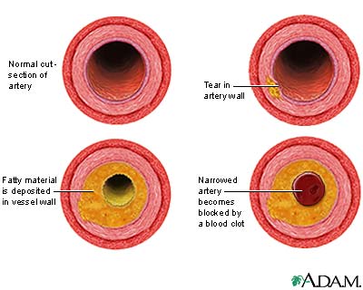 Developmental process of atherosclerosis Developmental process of atherosclerosis