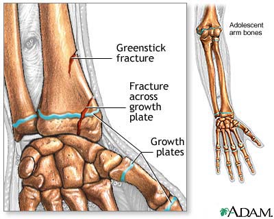 Fractures across a growth plate