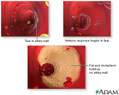 Arterial plaque build-up