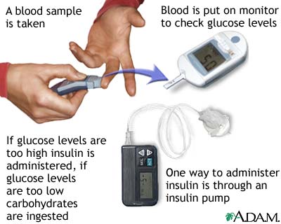 Glucose test