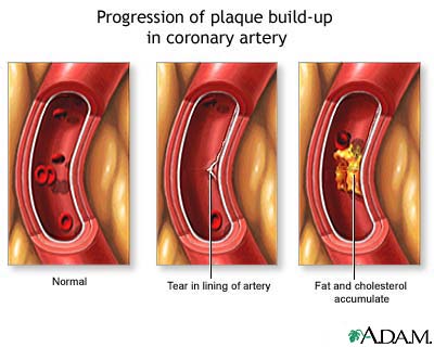 Progressive build-up of plaque in coronary artery Progressive build-up of plaque in coronary artery