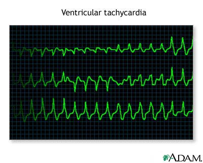 Ventricular tachycardia Ventricular tachycardia