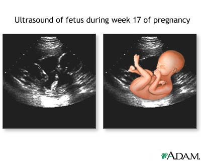 17 week ultrasound 17 week ultrasound