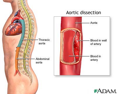 Aortic dissection