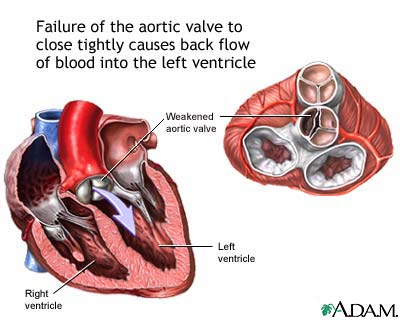 Aortic insufficiency Aortic insufficiency