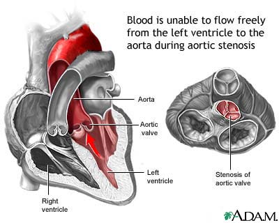 Aortic stenosis