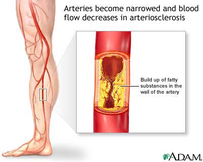 Arteriosclerosis of the extremities Arteriosclerosis of the extremities