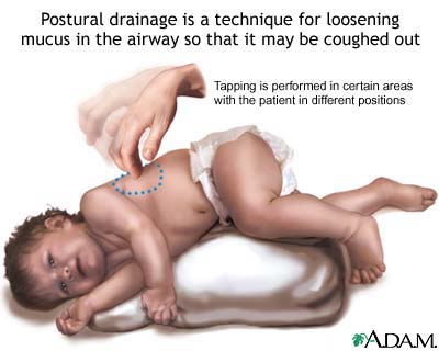 Postural drainage Postural drainage