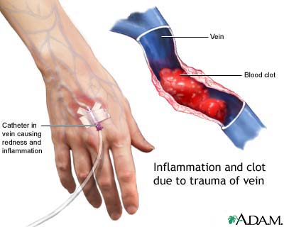 Superficial thrombophlebitis