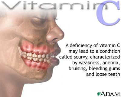 Vitamin C deficit Vitamin C deficit