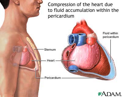 Cardiac tamponade