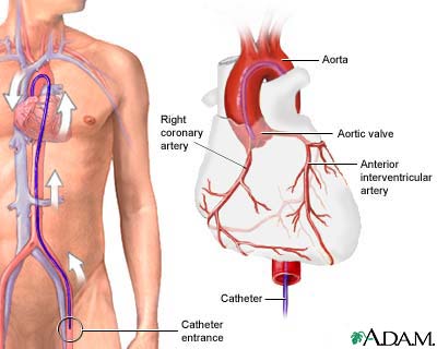 Coronary angiography Coronary angiography