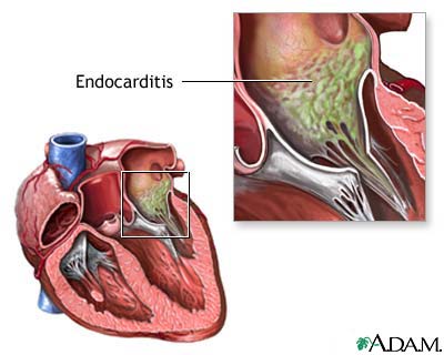 Culture-negative endocarditis Culture-negative endocarditis