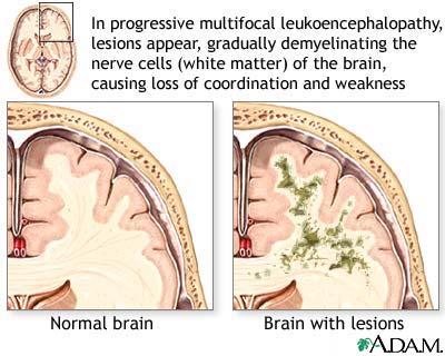 Leukoencephalopathy