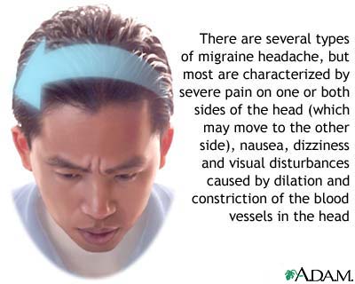 Migraine headache Migraine headache