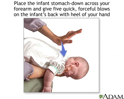 Heimlich maneuver on infant Heimlich maneuver on infant