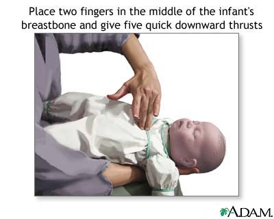 Heimlich maneuver on infant Heimlich maneuver on infant