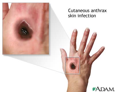 Cutaneous Anthrax Cutaneous Anthrax