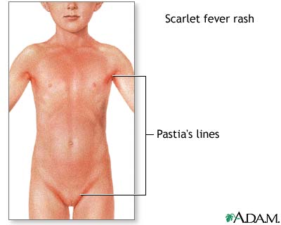 Signs of scarlet fever