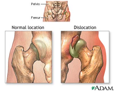 Dislocation of the hip Dislocation of the hip