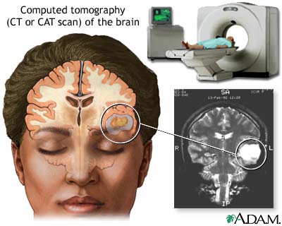 CT scan of the brain