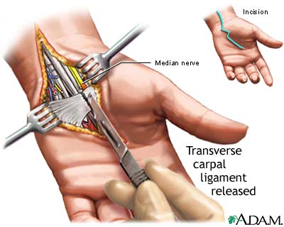 Carpal tunnel surgical procedure Carpal tunnel surgical procedure