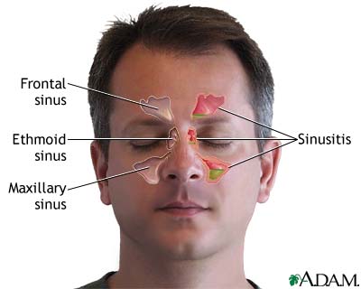 Sinusitis Sinusitis