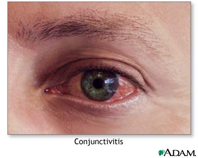 Conjunctivitis