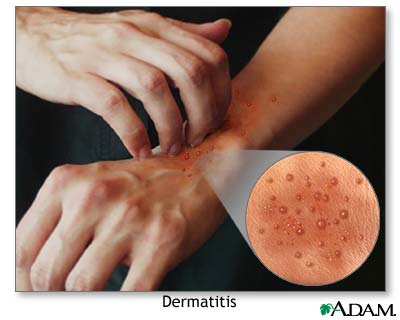 Atopic dermatitis