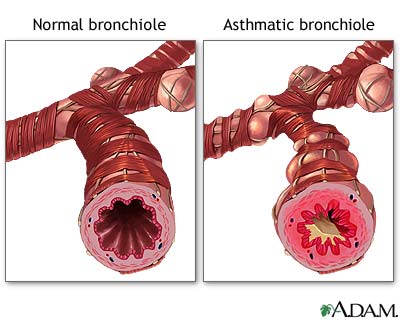 Normal versus asthmatic bronchiole Normal versus asthmatic bronchiole