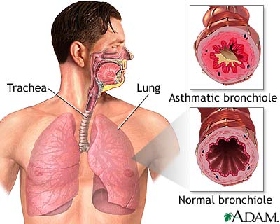 Asthmatic bronchiole and normal bronchiole Asthmatic bronchiole and normal bronchiole