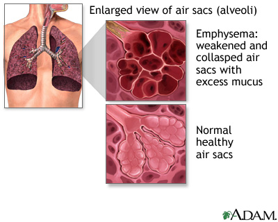 COPD (Chronic Obstructive Pulmonary Disorder)