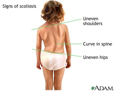 Signs of scoliosis Signs of scoliosis