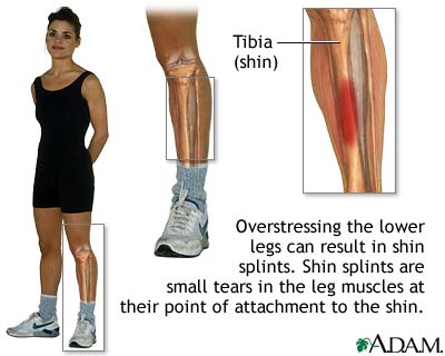 Shin splints