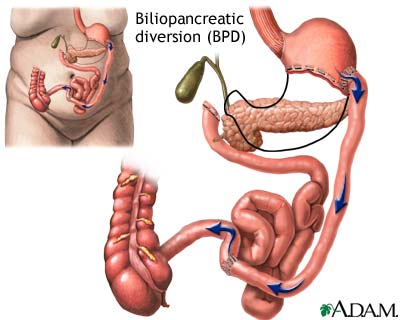 Biliopancreatic diversion (BPD)